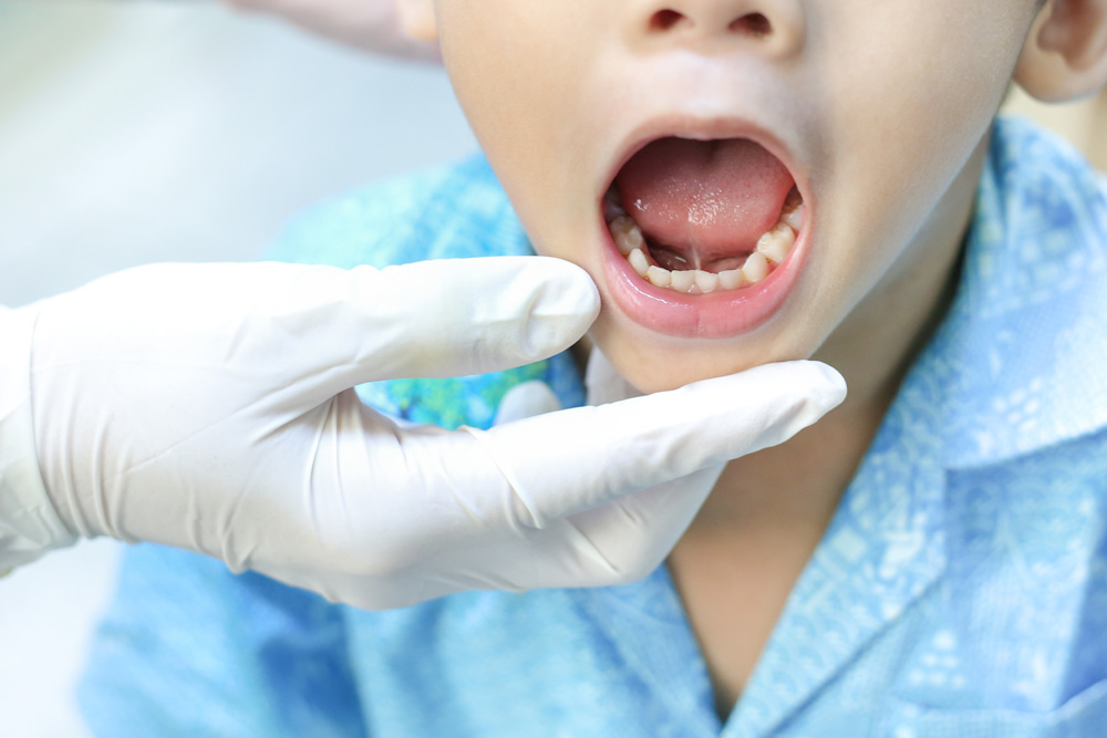 children show tongue-tie and teeth