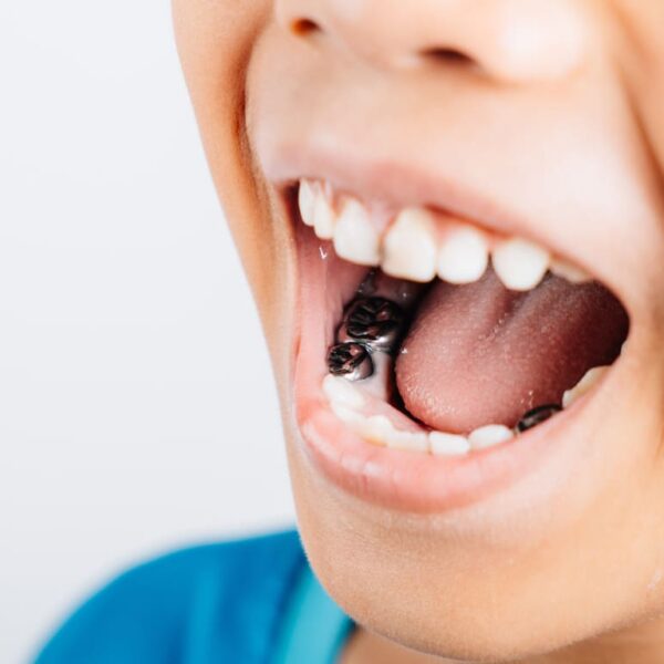 1 3 e1758195528458 - All Kids Pediatric Dentistry