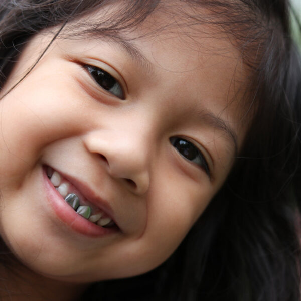 Asian little cute girl smiling with dental crown closed up the camera and her face dry skin in winter season