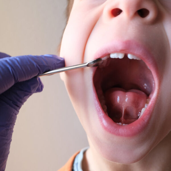 dentist, doctor examines oral cavity of small patient, length of frenum of the tongue, boy, kid performs articulation exercises for mouth, concept of speech disorders, correction