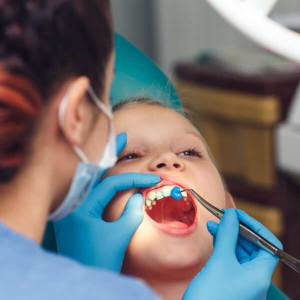 dentist fluoridates a child's teeth. Strengthening of tooth enamel