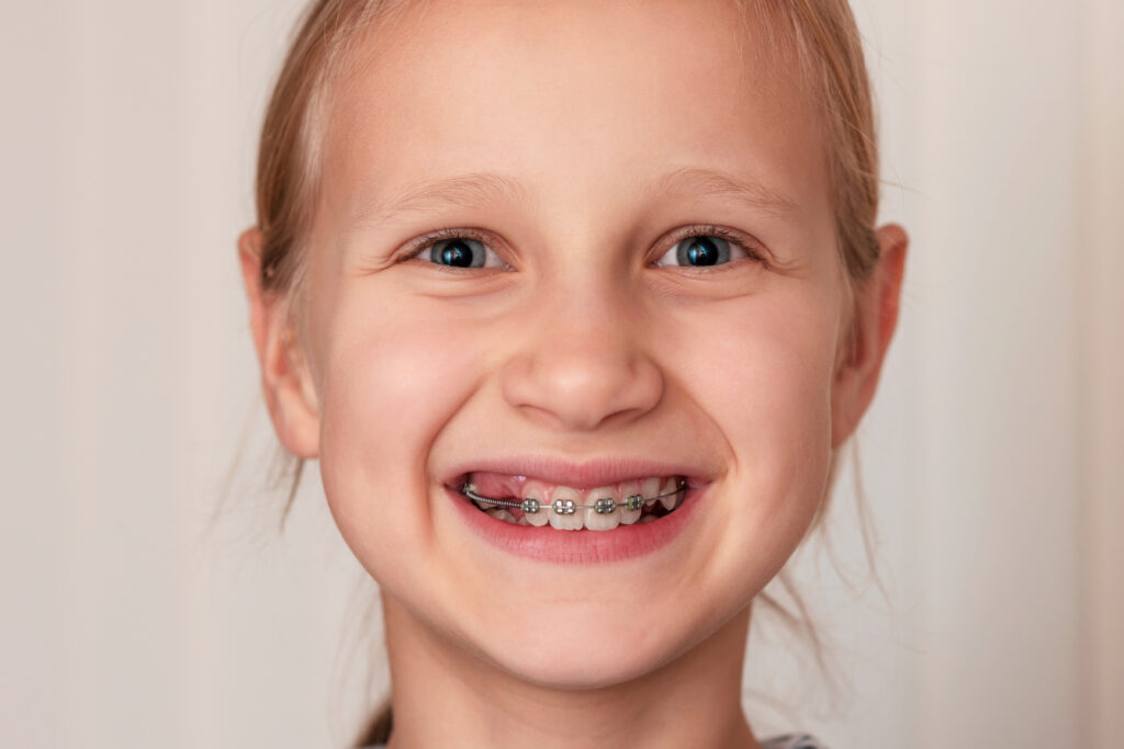 Braces Baby Teeth. Child Get Braces With Baby Teeth. Creating space - Braces create more room for Permanent Teeth. Correcting bite. Early intervention.