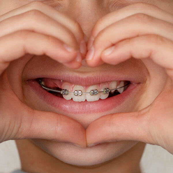 Dental Braces on Baby Teeth. Aligning teeth for Children. Teeth alignment. Orthodontic treatment