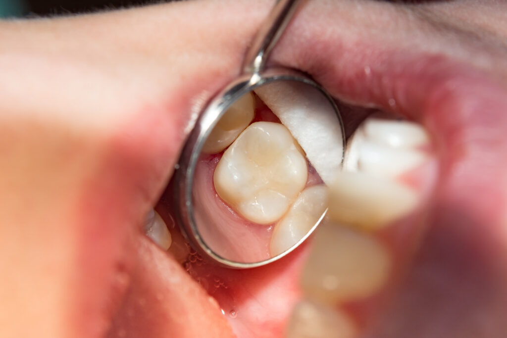 AdobeStock 187063042 2 - All Kids Pediatric Dentistry
